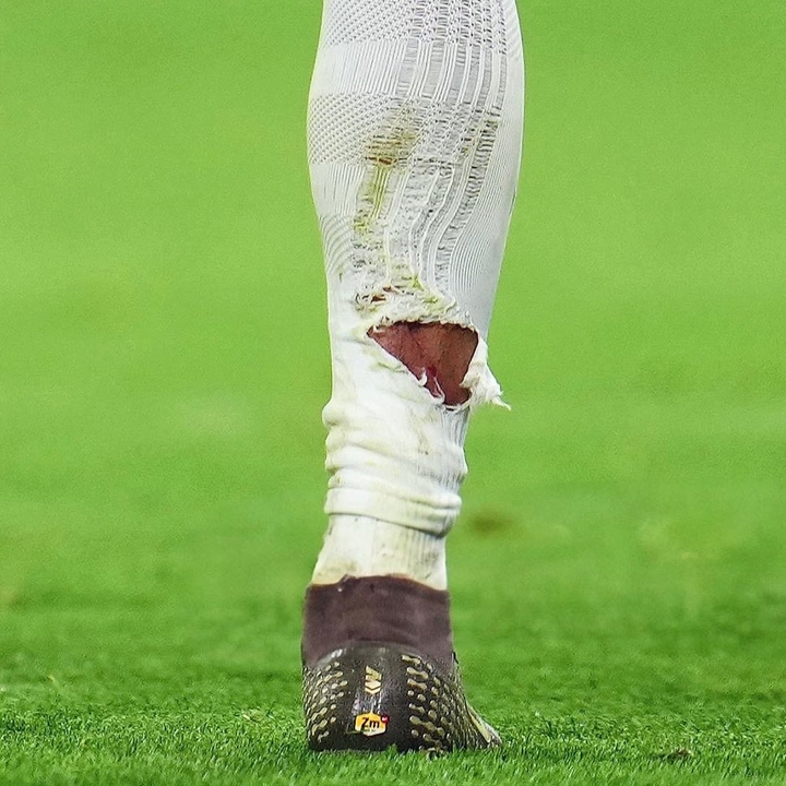 开云 体育-有点狠！塔蹬踏姆巴佩小腿染黄，姆巴佩小腿袜被踩破露出血痕